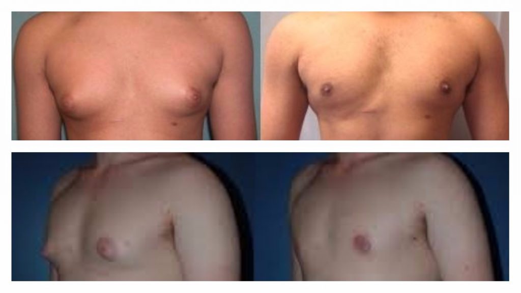 ginecomastia 16 años: tratamiento con cirugía estética de la ginecomastia en la pubertad