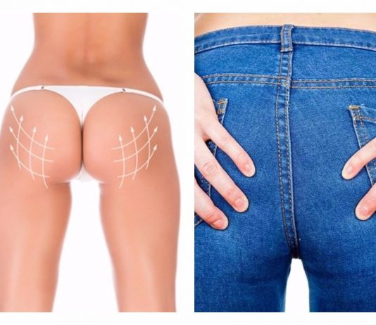 Brazilian Buttock Lift: lifting de glúteos brasileño