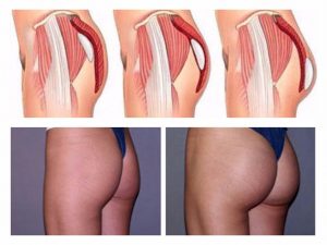 Lifting de glúteos brasileño o aumento de glúteos con implantes