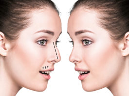 rinoplastia estetica y funcional