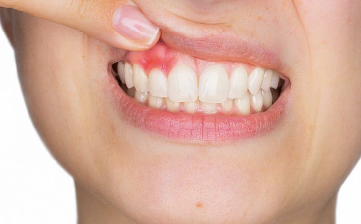 Encías inflamadas