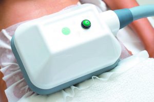Imagen de la máquina de Coolsculpting.
