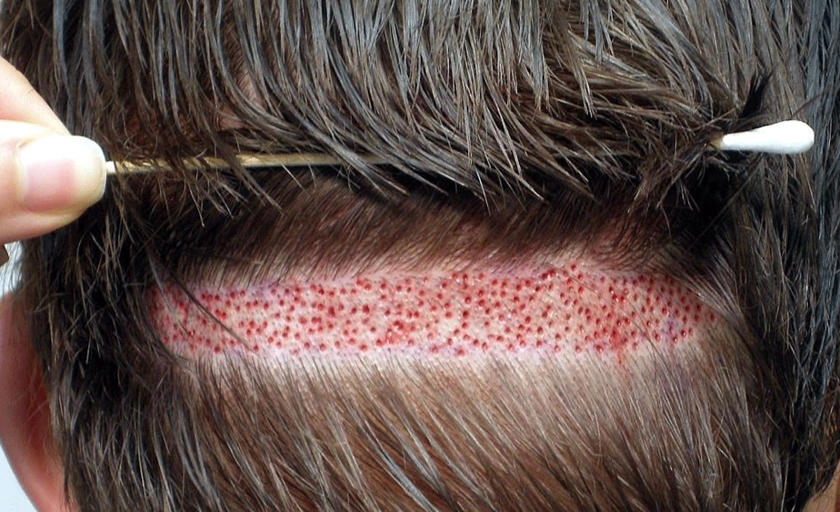 imagen detalle de un trasplante de pelo: los implantes capilares