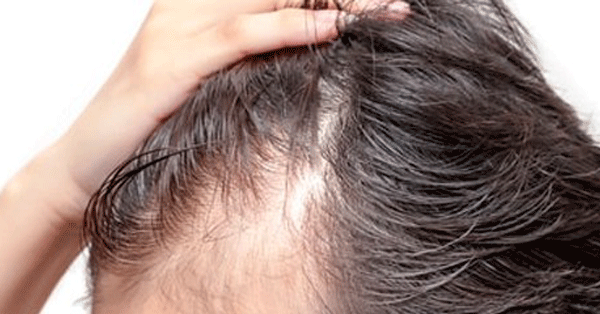 detalle de una cabeza donde no se ha resuelto del todo el trasplante de cabello