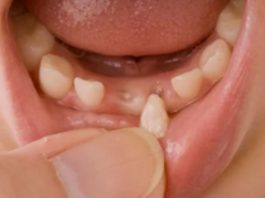 Los dientes de leche pueden contener gran cantidad de células madre.