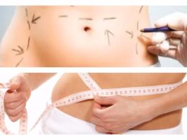 lipo-vaser-ultrasonica-precio