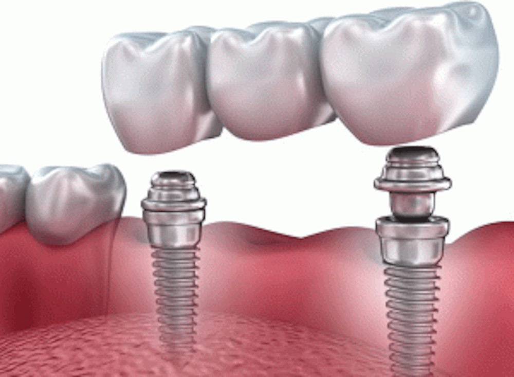 implantes dentales en clínicas Cleardent