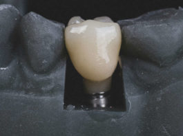 cuanto dura un implante dental