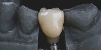cuanto dura un implante dental