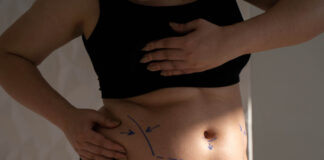 ¿Qué es una abdominoplastia y cuánto cuesta?