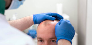 injerto capilar solución definitiva para la caída del pelo