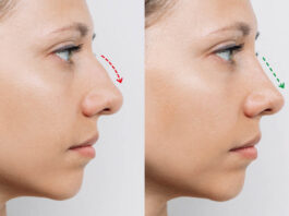rinoplastia en Valencia